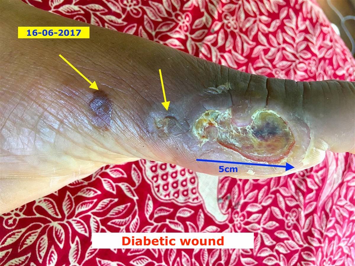 Diabetic wounds - Energetic Healing Center in Phuket 01